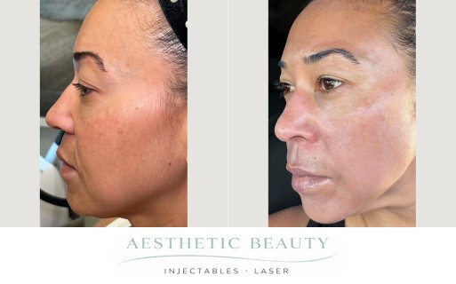 3D Miracl Before and After Image
