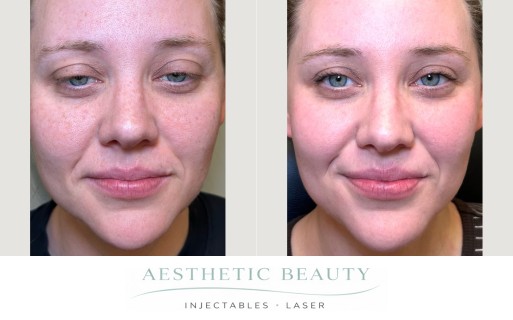 3D Miracl Before and After Image