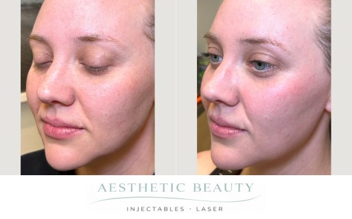3D Miracl Before and After Image