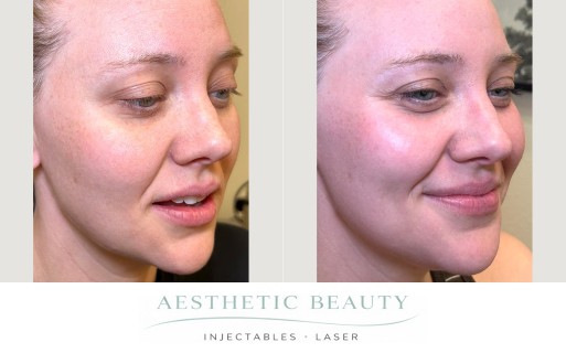 3D Miracl Before and After Image