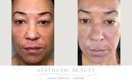 3D Miracl Before and After Image