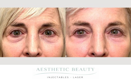 EZ Gel Before and After Image