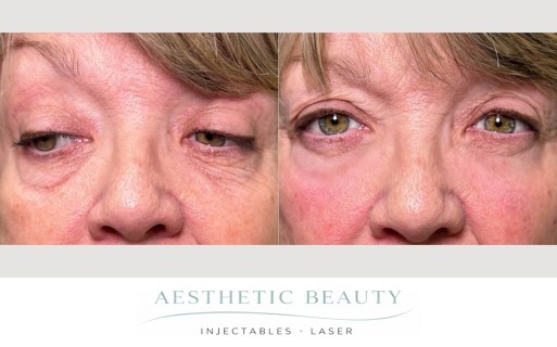 EZ Gel Before and After Image