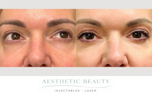 EZ Gel Before and After Image