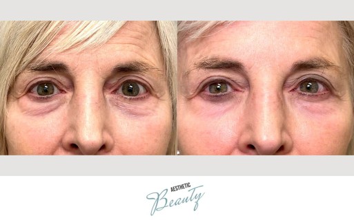 EZ Gel Before and After Image