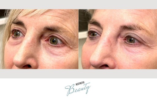 EZ Gel Before and After Image