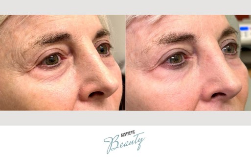 EZ Gel Before and After Image