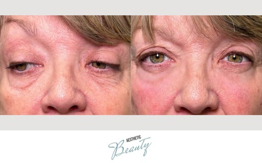 EZ Gel Before and After Image