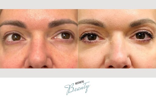 EZ Gel Before and After Image