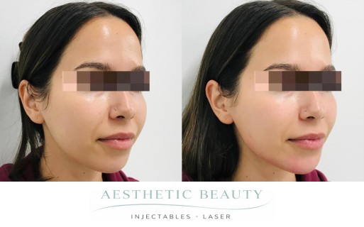Filler - Chin and Jawline Before and After Image