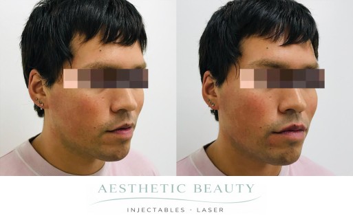 Filler - Chin and Jawline Before and After Image