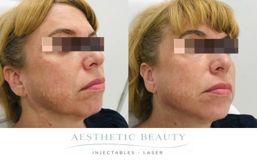 Filler - Chin and Jawline Before and After Image