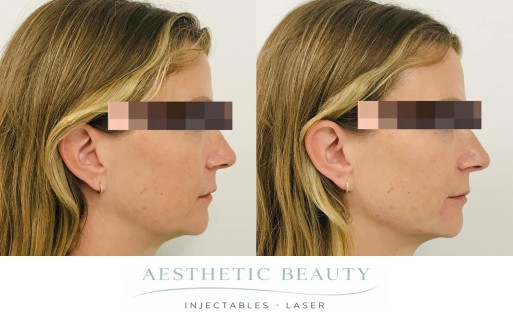 Filler - Chin and Jawline Before and After Image