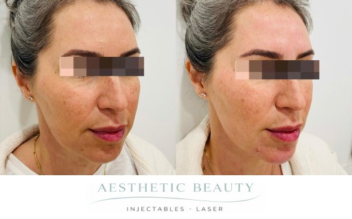 Filler - Chin and Jawline Before and After Image