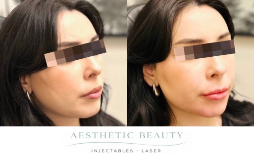 Filler - Chin and Jawline Before and After Image