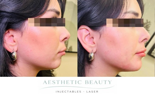 Filler - Chin and Jawline Before and After Image