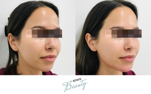 Filler - Chin and Jawline Before and After Image