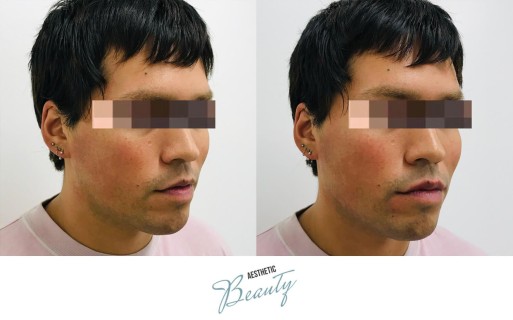 Filler - Chin and Jawline Before and After Image