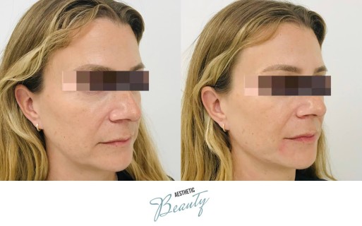 Filler - Chin and Jawline Before and After Image