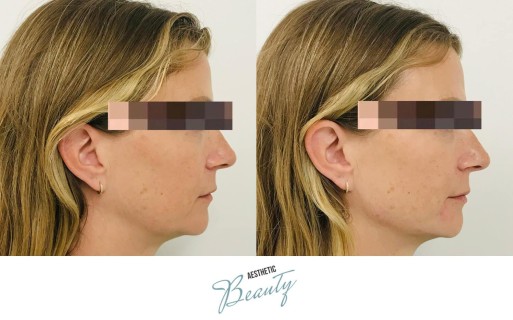 Filler - Chin and Jawline Before and After Image