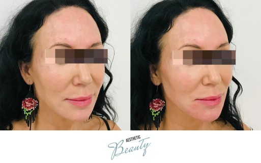 Filler - Chin and Jawline Before and After Image