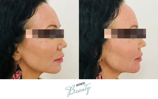 Filler - Chin and Jawline Before and After Image