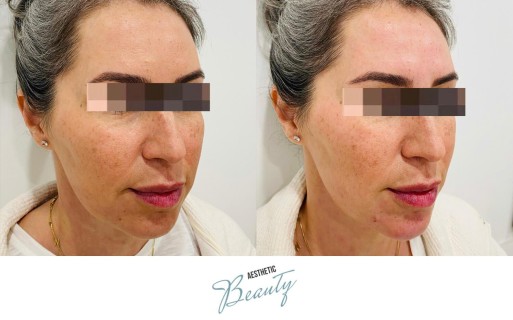 Filler - Chin and Jawline Before and After Image