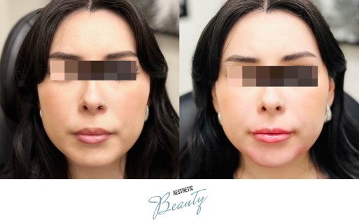 Filler - Chin and Jawline Before and After Image
