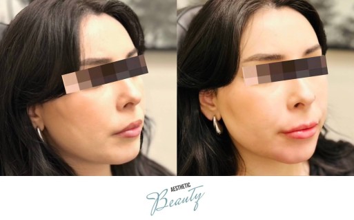 Filler - Chin and Jawline Before and After Image
