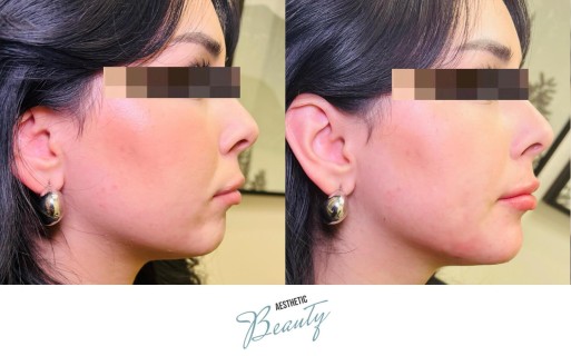 Filler - Chin and Jawline Before and After Image