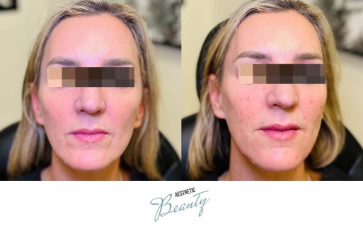 Filler - Chin and Jawline Before and After Image