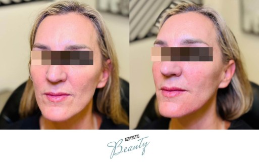 Filler - Chin and Jawline Before and After Image