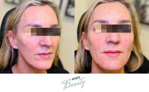 Filler - Chin and Jawline Before and After Image