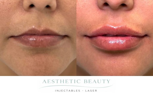 Lips Before and After Image