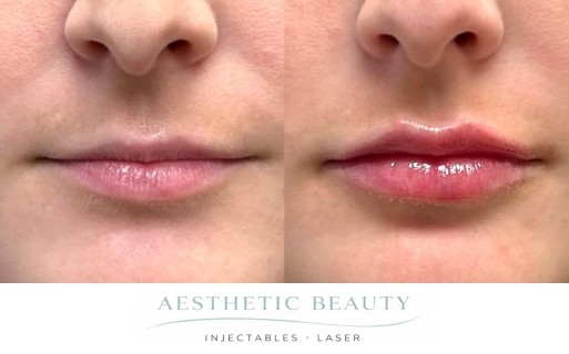 Lips Before and After Image