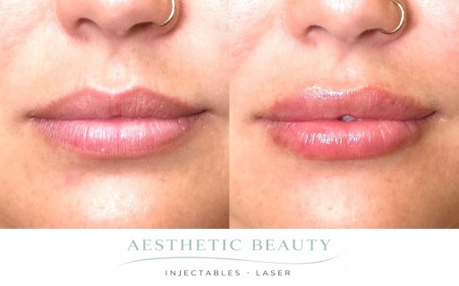 Lips Before and After Image