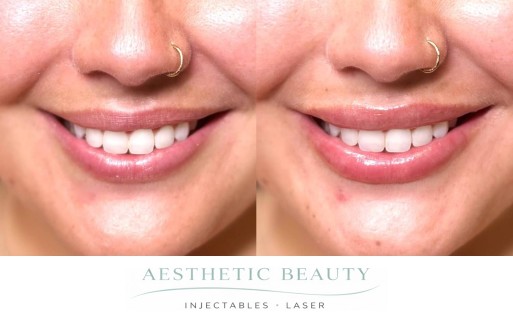 Lips Before and After Image