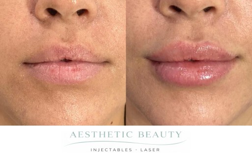 Lips Before and After Image