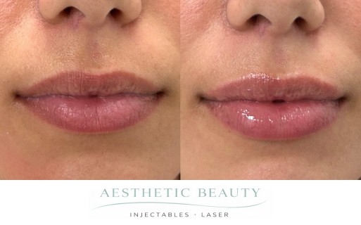 Lips Before and After Image