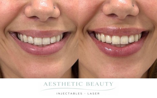 Lips Before and After Image