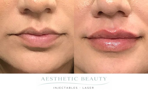 Lips Before and After Image
