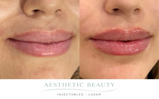 Lips Before and After Image