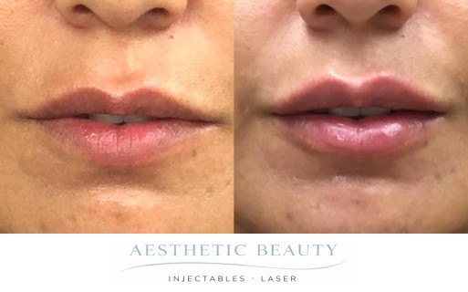 Lips Before and After Image