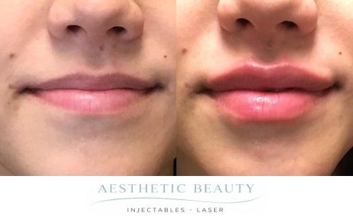 Lips Before and After Image