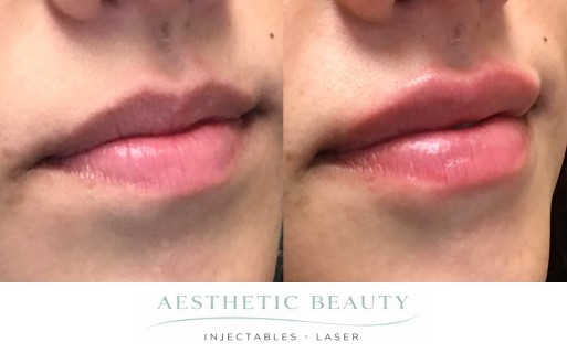 Lips Before and After Image