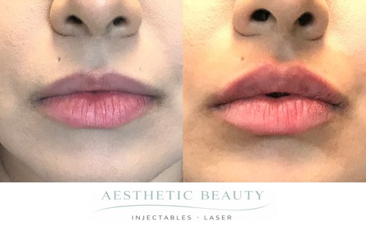Lips Before and After Image