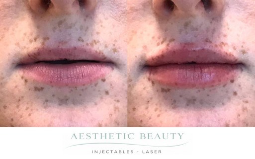 Lips Before and After Image