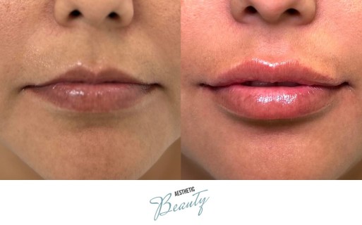 Lips Before and After Image