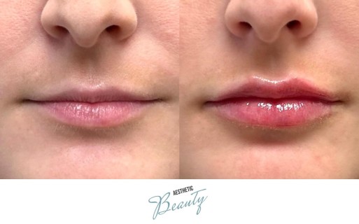 Lips Before and After Image