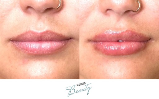 Lips Before and After Image
